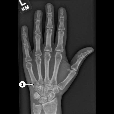 Hand X-Ray Tips