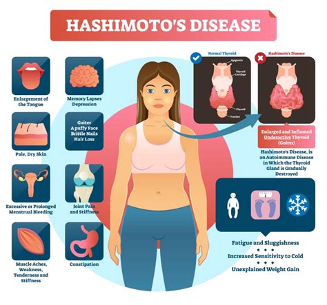 Hashimoto Disease