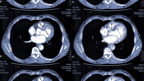 Heart Scans