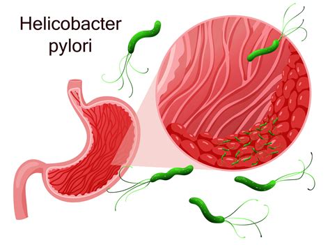 Helicobacter pylori Infections