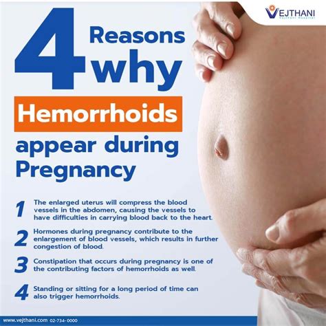 Hemorrhoid Relief During Pregnancy