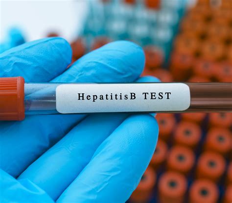 Hepatitis B Testing in Special Populations