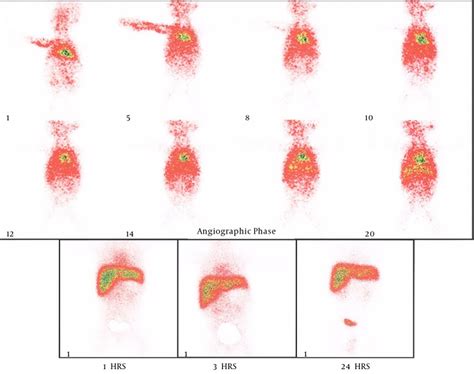 Hida Scan Results