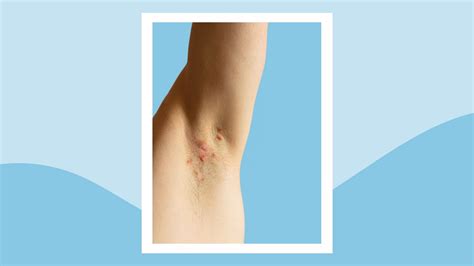 Hidradenitis Suppurativa