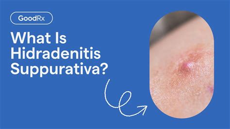 Hidradenitis Suppurativa Complications