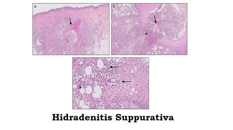 Hidradenitis Suppurativa Symptoms