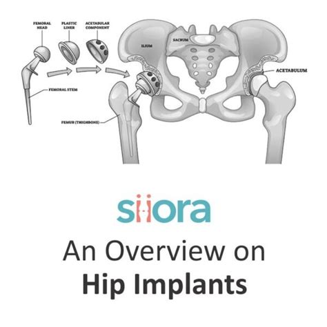 Types of hip implants
