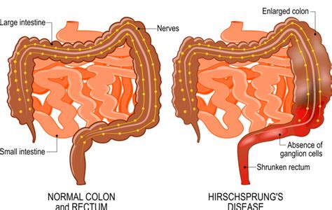 Hirschsprung's Disease Causes