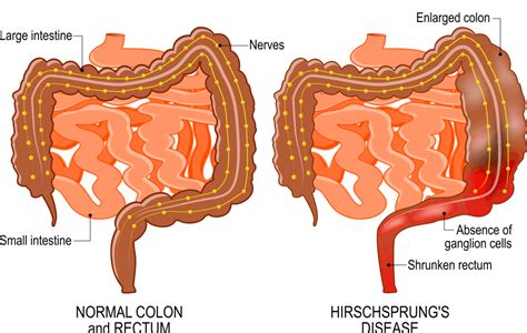 Hirschsprung's Disease Complications