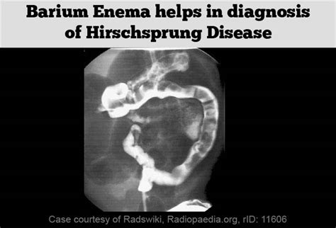 Hirschsprung's Disease Diagnosis