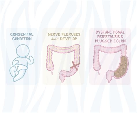 Hirschsprung's Disease Research