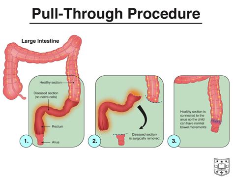 Hirschsprung's Disease Treatment