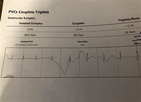 Interpreting Holter Results
