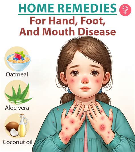 Home Remedies For Hand Foot And Mouth Disease