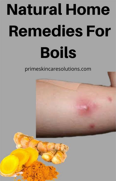 Home Remedies for Boils