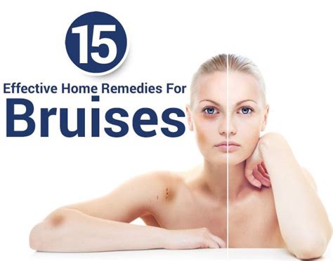 Home Remedies for Bruising
