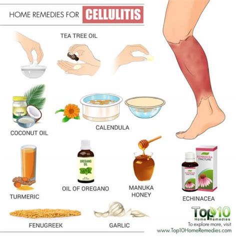 Home Remedies for Cellulitis