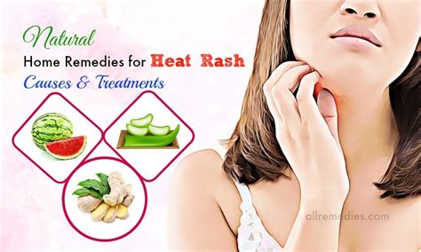Home Remedies for Heat Rash