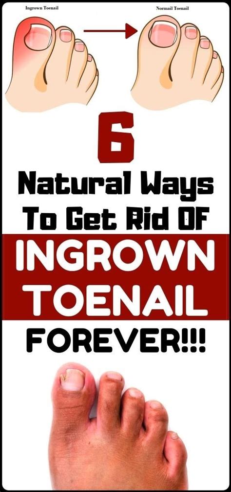 Home Remedies for Ingrown Toenails