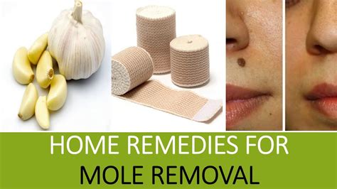 Home Remedies for Mole Removal