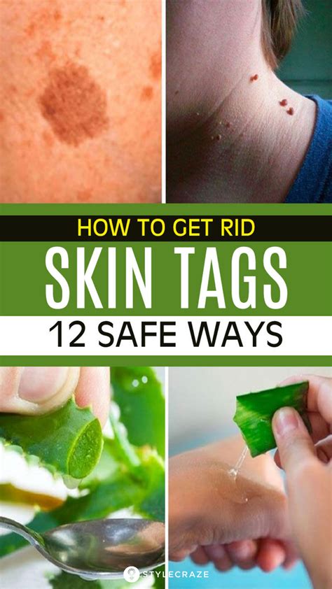 Home Remedies for Removing Skin Tags