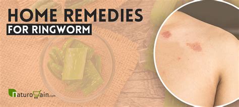 Home Remedies for Ringworm
