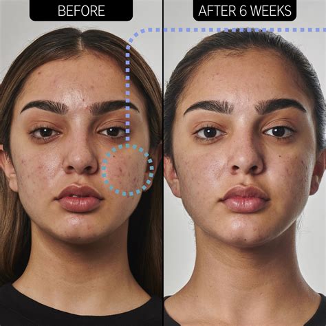 How Benzoyl Peroxide 5 Acne Treatment Works