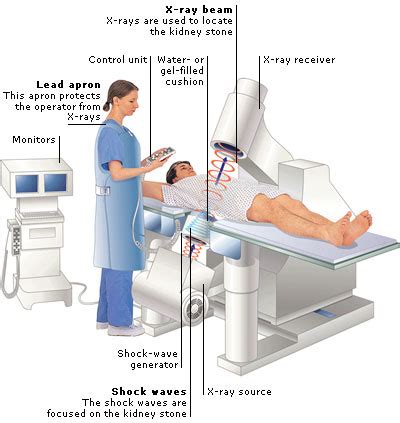 How Lithotripsy Works