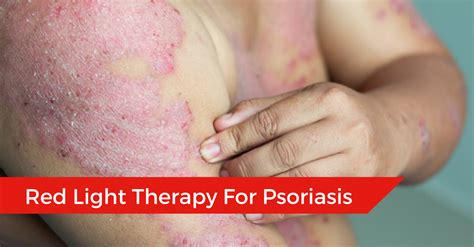 How Psoriasis Light Therapy Works