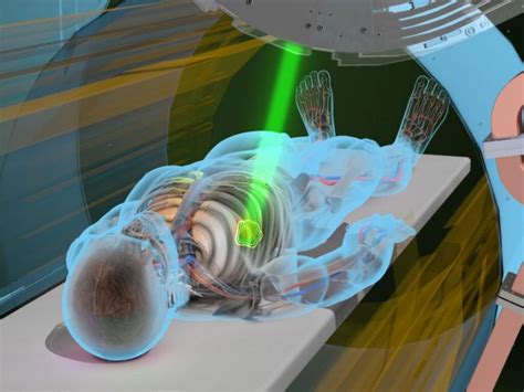 How Radiation Therapy Works