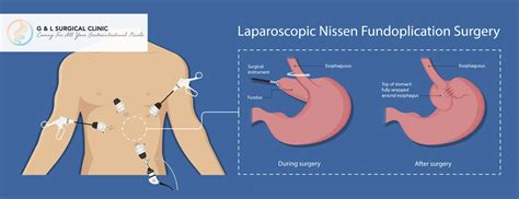 How Reflux Surgery Works