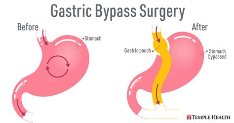How Roux En Y Gastric Bypass Surgery Works