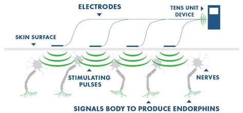 How TENS Units Work