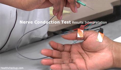 How to Prepare for a Nerve Conduction Test