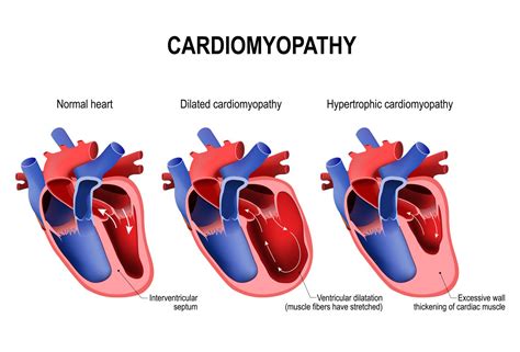 Hypertrophic Cardiomyopathy