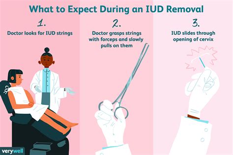 IUD Removal Process
