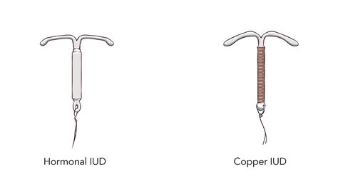 IUD Types