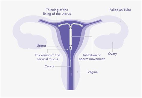 IUD Working Mechanism