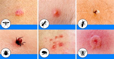 Identifying Circular Bug Bites
