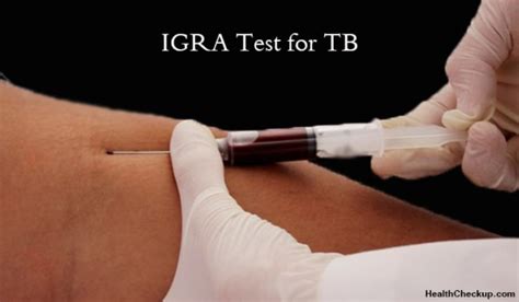 Igra Blood Test and Public Health
