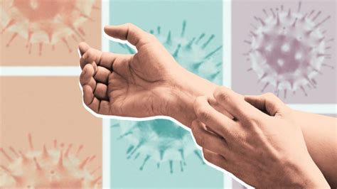 Impact of Covid Rash on Patient Outcomes