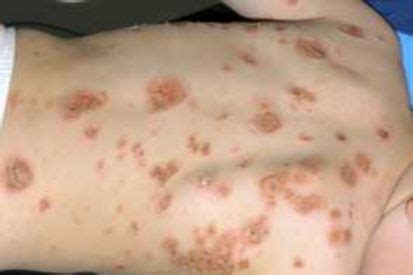 Impetigo Causes