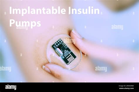 Implantable Insulin Devices