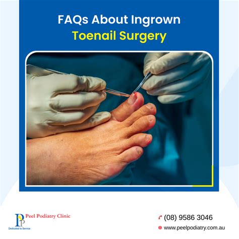 Ingrown Nail Toe FAQs