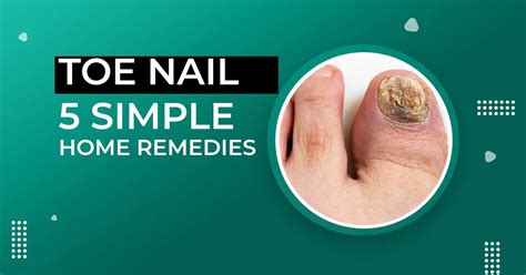 Ingrown Nail Toe Home Remedies