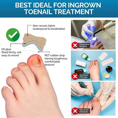Ingrown Nail Toe Prevention