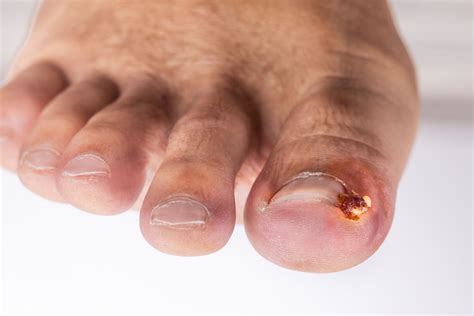 Ingrown Nail Toe Symptoms