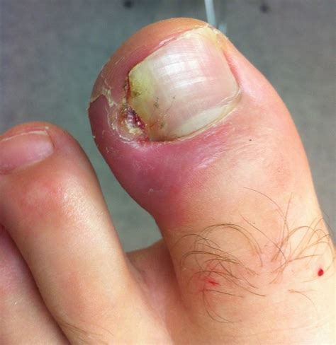 Ingrown Nail Toe Treatment