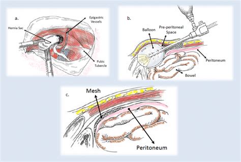 Inguinal Hernia Repair Surgery Overview