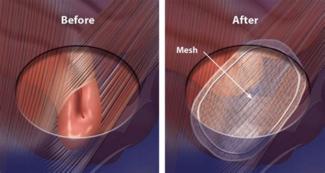 Inguinal Hernia Surgery Repair Benefits